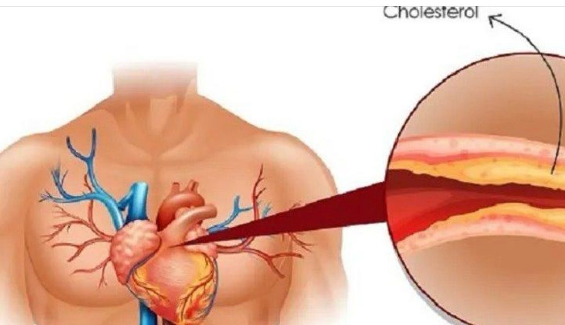 उच्च कोलेस्ट्रोल कम गर्न यी २ चिज आजैबाट खान सुरु गर्नुहोस् !