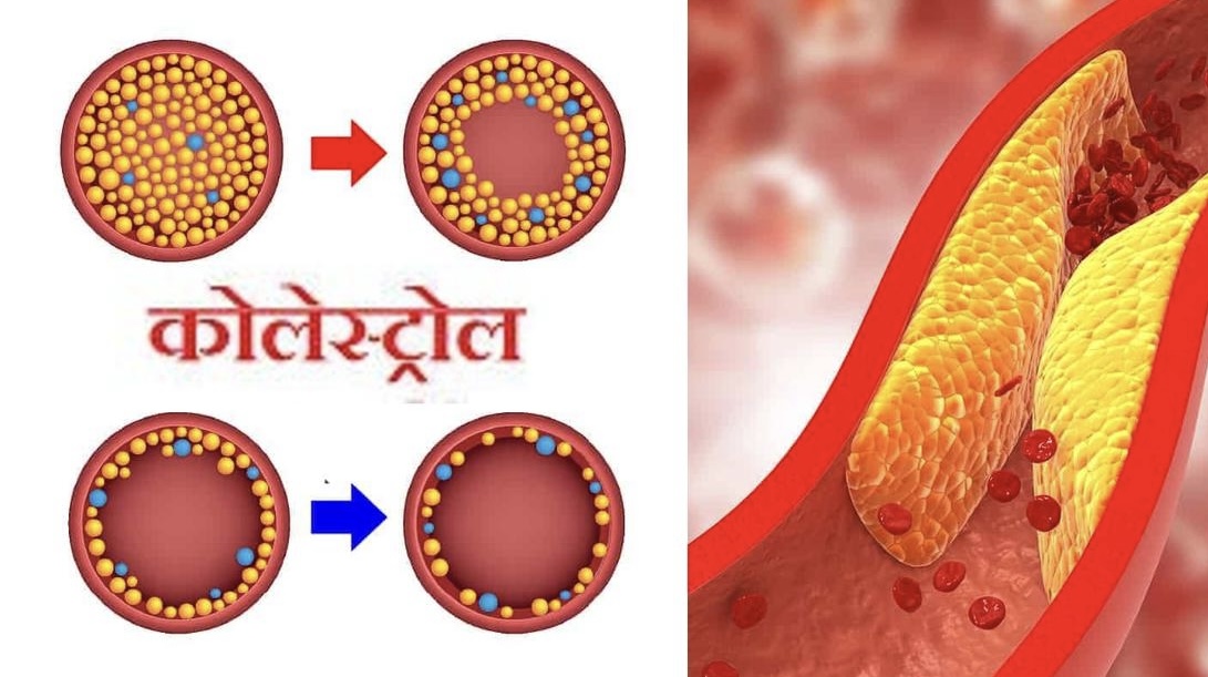 शरीरमा कोलेस्ट्रोल बढेको कसरी थाहा पाउने ? कसरी नियन्त्रण गर्ने ? जानी राखौ