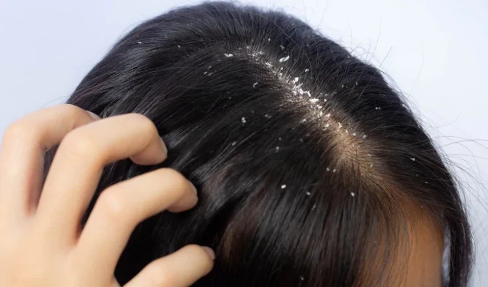 कपालमा चाया पर्ने समस्या छ? अपनाउनुस् घरेलु उपाय
