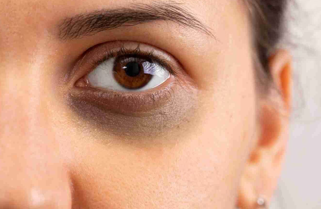 के कारणले आउँछ डार्क सर्कल ?कसरी हटाउने त डार्क सर्कल ?