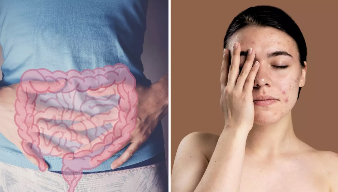 के पेटको स्वास्थ्य बिग्रिएपछि अनुहारमा टेनिङ सुरु हुन्छ ?