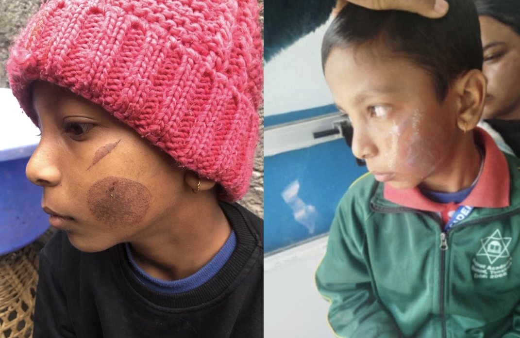 विद्यार्थीले ‘काली’ भनेको आक्रोशमा चार विद्यार्थीको गालामा तातो पन्यूले डाम्ने शिक्षिका पक्राउ