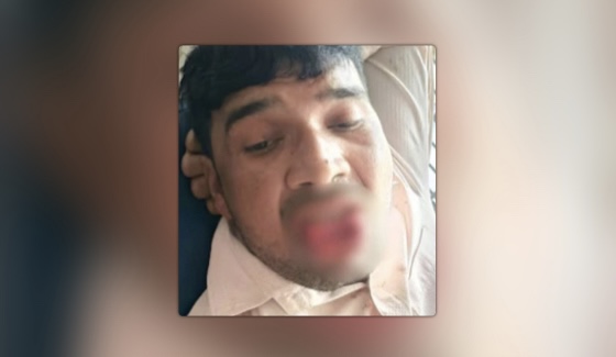 पूर्वप्रेमीले चुम्बन गर्न खोज्दा युवतीले दाँतले टोकेर जिब्रो काटिदिएपछि…