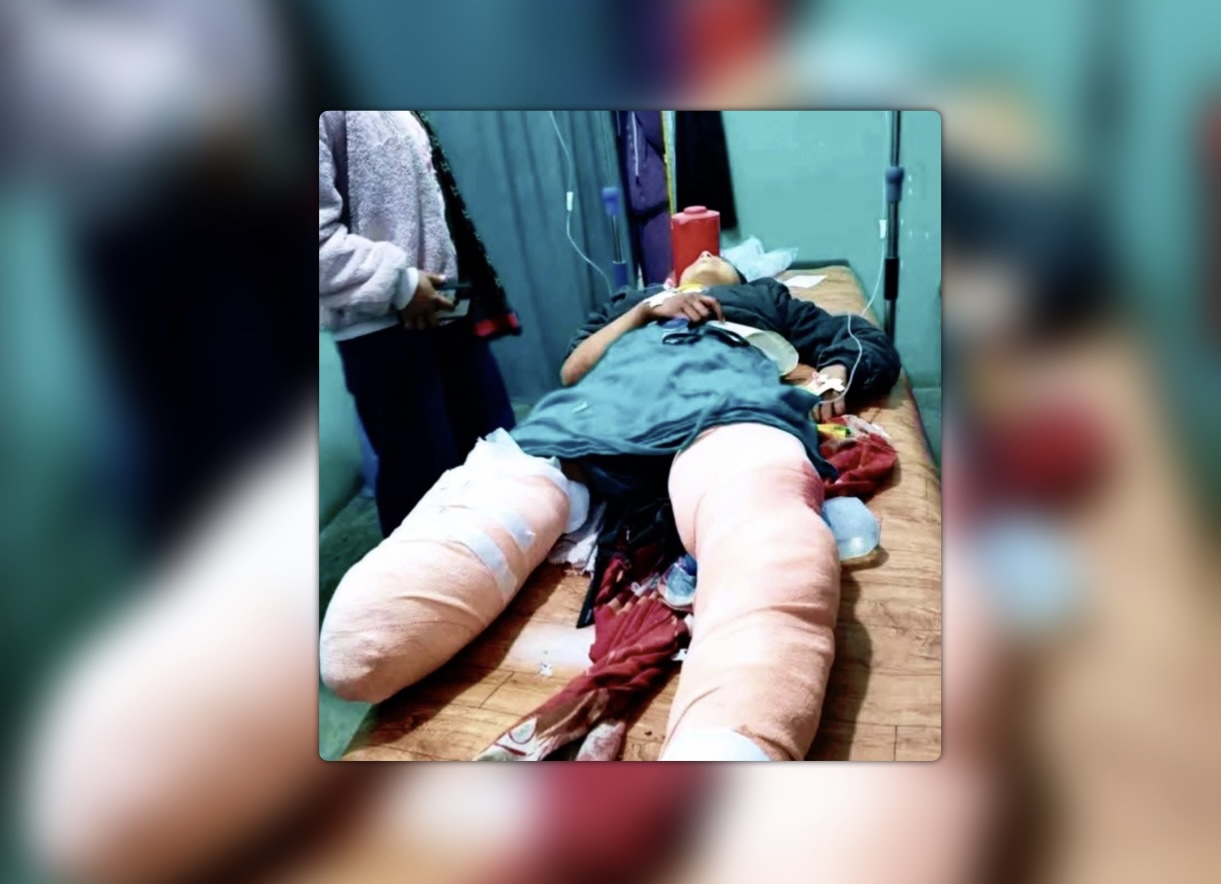 विद्यालयबाट घर फर्किँदै गर्दा भिरबाट खसेको ढुङ्गा लागेर ११ वर्षीया बालिका पुष्पा थापा गम्भीर घाइते